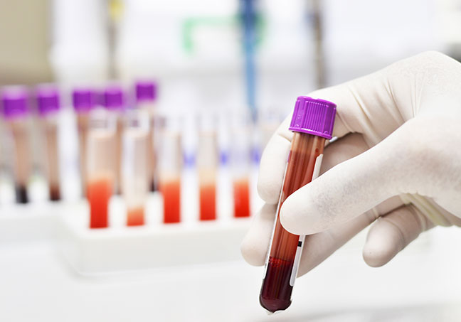Hemophilia.jpg Hemophilia