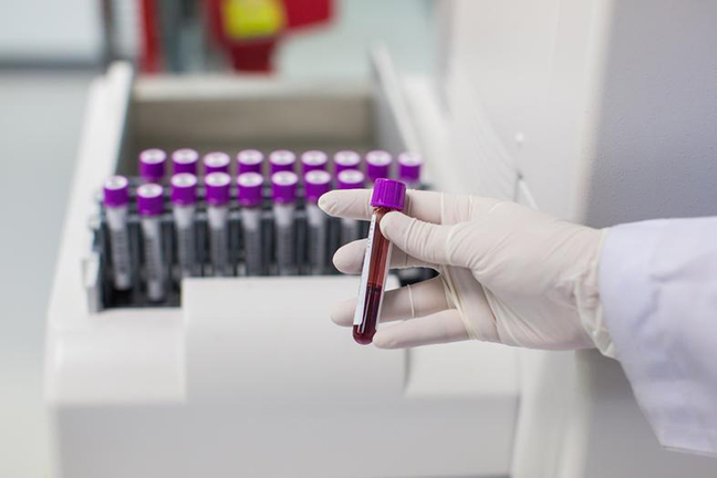 lipid-testing.jpg lipid testing